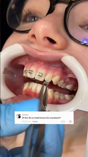 Top Reasons Why You Need Braces