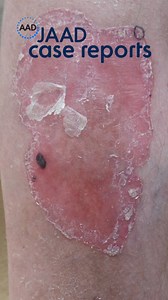 4.6K views · 53 reactions | What is the most likely diagnosis? Visit JAAD Case Reports to find out: https://bit.ly/3FAMjVC | Journal of the American Academy of Dermatology (JAAD) | Facebook