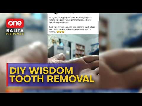 35-anyos na ginang, nag-DIY wisdom tooth extraction | One Balita Pilipinas