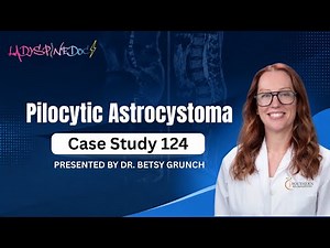 Case study 124 | Pilocytic Astrocystoma Diagnosis & Treatment | Explained by Dr. Grunch