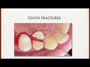 Tooth fracture injuries ( modified Ellis fracture classification)