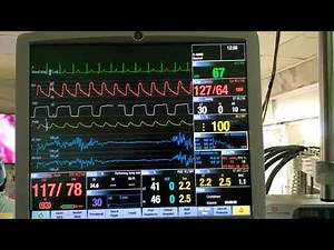 Adenosine induced transient cardiac arrest