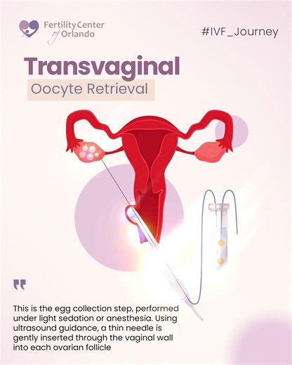 For many people, the process of IVF has always seemed complex and mysterious. That’s why, over the next few days, we’ll take you on an educational journey through each stage of the IVF process 2. Transvaginal Oocyte Retrieval This is the egg collection step, performed under light sedation or anesthesia. Using ultrasound guidance, a thin needle is gently inserted through the vaginal wall into each ovarian follicle. The fluid containing the eggs is aspirated and collected into test tubes. An embry