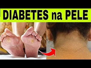 9 SINAIS de DIABETES na PELE