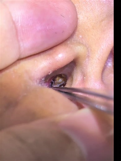 asmr short video #earwaxremoval #asmr #earcleaning #satisfying