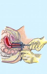 LEGRADO UTERINO - Aula Ginecología
