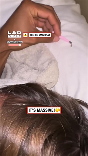 There was a botfly in my son's head 🥴🤢 | LADbible