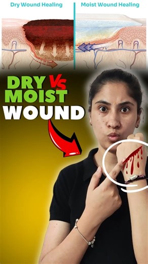Moist Wounds Heal Faster?! The Truth You Never Knew!