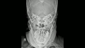Reverse Towne View Radiograph for Mandible Imaging