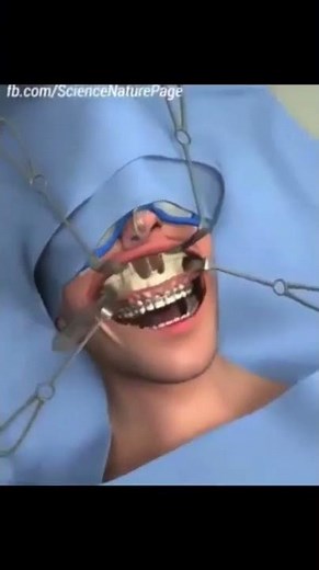 AMO Anterior Maxillary Osteotomy Lefort 1, Mid Face maxillofacial surgery Bimax surgery