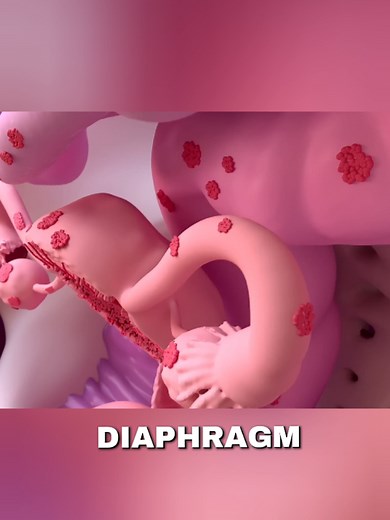 In this 3D animated video, I explain what endometriosis is, its complications, possible causes, and how it can be treated#symptoms #canser #cesareansection
