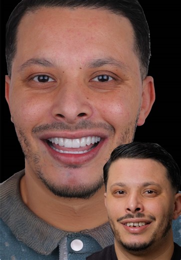 📌Following the extraction of teeth with poor prognosis, a fixed, functional, and esthetic rehabilitation was achieved using the All-on-Four implant concept and a hybrid prosthesis. 📌Uzun dönem korunması mümkün olmayan dişler dişlerin çekimi sonrası, All-on-Four implant konsepti ve hibrit protez ile sabit, fonksiyonel ve estetik bir rehabilitasyon sağlandı. #smilemakeover #smiledesigner #smiledesign #implant