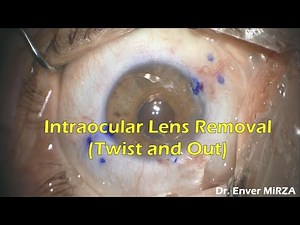 Intraocular Lens Removal (Twist and Out) | IOL Explantation
