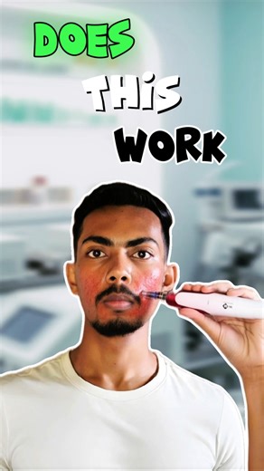 Acne scars kaise htaye 🤔