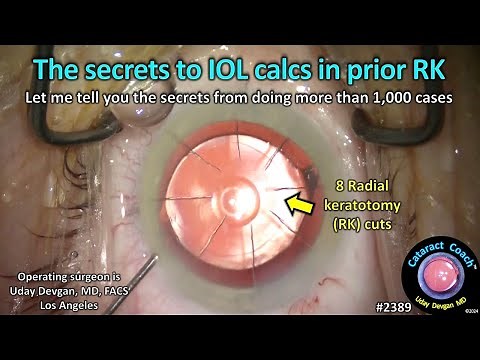 CataractCoach™ 2389: the secrets IOL calcs prior RK radial keratotomy