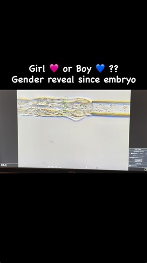 Embryologist Putri on Instagram: "Embryo biopsy is the removal of several trophectoderm cells from a day-5/6 blastocyst for preimplantation genetic testing (PGT), while preserving the inner cell mass. 🔬 Through PGT-A, embryo sex is accurately identified by analyzing X and Y chromosomes. Benefits: ✍🏼 99% accuracy for sex determination ✍🏼 Enables sex-linked genetic disease prevention ✍🏼 Allows informed embryo selection before transfer #ivf #ivfsuccess #ivfjourney #embryotransfer #lab"