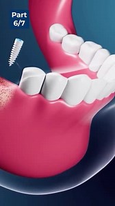 Part 6: Options for Missing Front Teeth : Dental Surgeon Explains. 🦷 #dental #dentalimplants #teeth #doctor | Nuvia Dental Implant Center