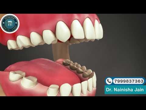 Dental Bridge Explained | How It Replaces a Missing Tooth|Dr.Nainishha Jain