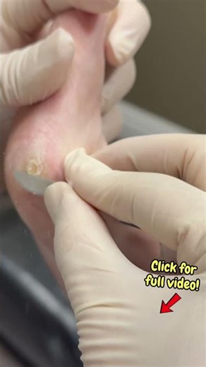 Part 2: Unusual Corn Buried Deep in the Side of the Toe | Extreme Corn Removal #satisfyingshorts