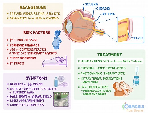Central Serous Retinopathy: What It Is, Causes, Signs and Symptoms | Osmosis