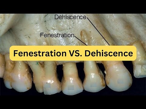 Difference between fenestration and dehiscence with mnemonic!
