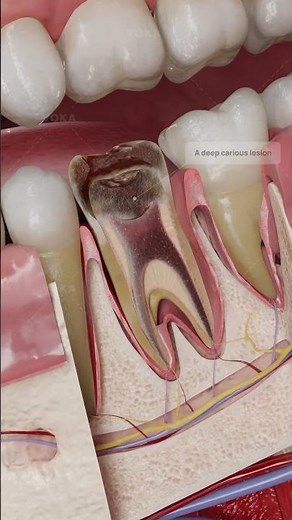 ¿Qué es la pulpitis crónica irreversible? Odontología en 3D