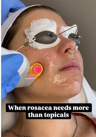 Excel V Laser for Rosacea Redness & Flushing