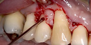 Prof. Leonardo Trombelli: Single Flap Approach in combination with Enamel Matrix Derivative, Straumann® Emdogain® in the treatment of Periodontal Intraosseous Defects