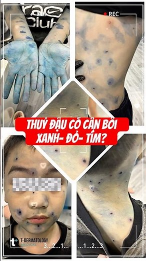 Thủy đậu: Đừng lạm dụng thuốc xanh đỏ, chăm sóc đúng cách mới giúp da nhanh lành và hạn chế sẹo