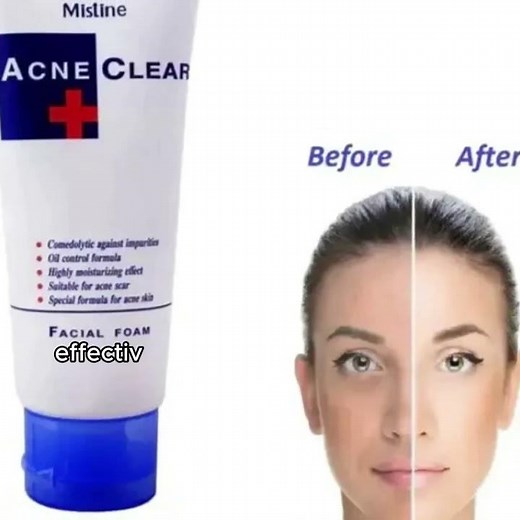 Mistine acne clear face wash facial foam