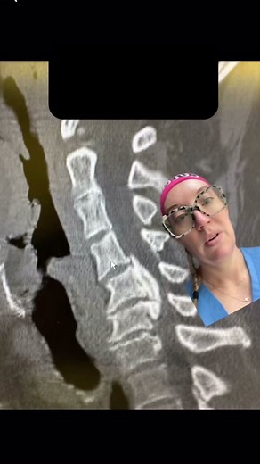 Case study 81 - Ossification of the Posterior Longitudinal Ligament (OPLL) Ossification of the posterior longitudinal ligament, also referred to as OPLL, is a spinal condition where the posterior longitudinal ligament becomes calcified and less flexible. The posterior longitudinal ligament runs the entire length of the spine from the neck to the end of the spine and stabilizes the spinal column bones. The exact cause of OPLL is unknown, but it typically occurs when the soft tissues on the spine