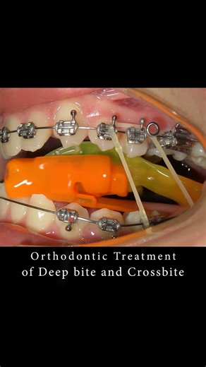 Braces can change smile - Deep bite! #braces #orthodontist #dentist #smilemakeover