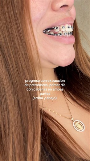 Progreso con cadenas en brackets tras extracción de premolares