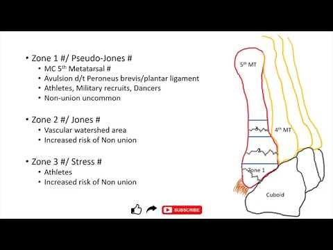 Jones fracture and Pseudo-Jones fracture ; differences