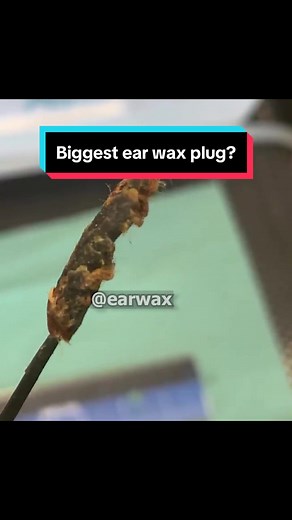 Biggest Ear Wax Plug Removal Video