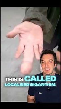 Localized gigantism 👆