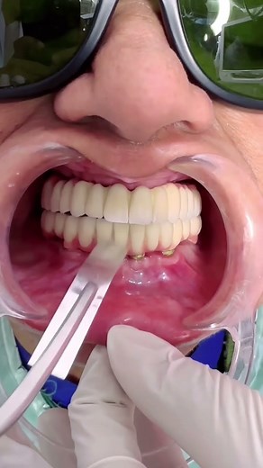 Checking implant occlusion using Shimstock for static occlusion #delhidentist #fullmouthdental