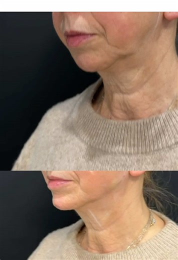 Before and immediately after suture suspension, jawline/ cheekbone/ chin augmentation, and neuromodulator to the neck bands. This is a fully nonsurgical approach for those who prefer to defer or delay a surgical necklift. #beautyisinthedetails #plasticsurgeon #plasticsurgery