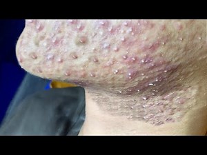 New Acne Treatments 2025 | Acne Removal | Pimples Removal | Acne Extraction | Pimple Popping