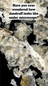 Dandruff under the Microscope! #education #scienceshorts #science