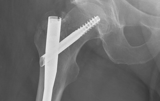 Why Hip Fractures Require Surgery & Treatment | UTSW Medical Center - MedBlog