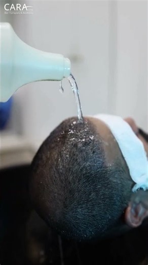 Are you washing your hair wrong after surgery? #hairtransplant #skincare