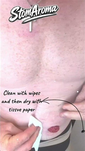 POV Stoma Change - #StomaBag #OstomyTips #StomaCare