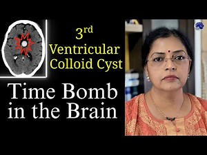 Colloid Cysts: This Brain tumor symptom should not be ignored!