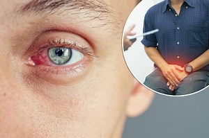 Don’t blindly ignore it: Here’s why your eye pain might actually be an STI