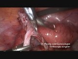 Dermoid Ovarian Cystectomy (for resident) • Video • MEDtube.net