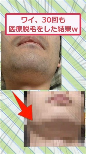 The Results of My 30 Laser Hair Removal Sessions lol #2chFunnyThreads #2ch #5ch #shorts