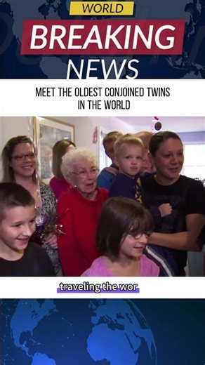 MEET THE OLDEST CONJOINED TWINS IN THE WORLD. #news