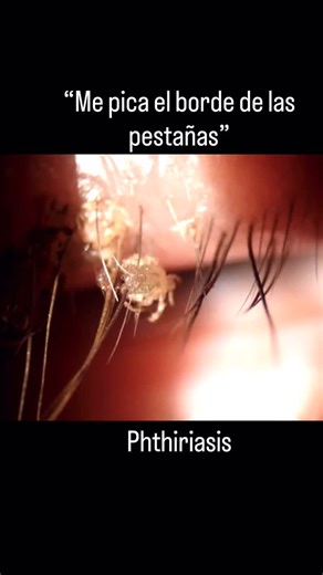 Dr Juan Carlos Serna | Oftalmólogo on Instagram: "¿Piojos en las pestañas? La pediculosis, también conocida como ladillas, es una infección parasitaria causada por el piojo Pthirus pubis. Se transmite principalmente por contacto s3xu@l, pero también puede contagiarse por contacto físico con una persona infectada. Los síntomas principales son picazón intensa y la presencia de liendres (huevos de piojos) o piojos arrastrándose. Original: Jason Compton"