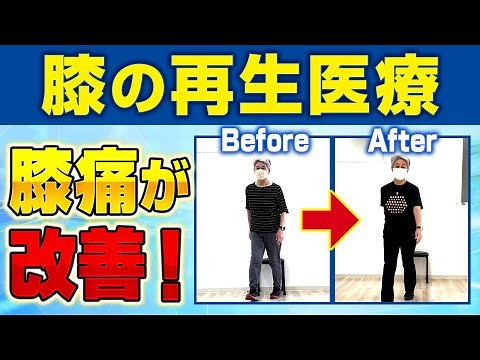 【膝の再生医療】膝の痛みが改善した患者さん体験談【PRP-FD】